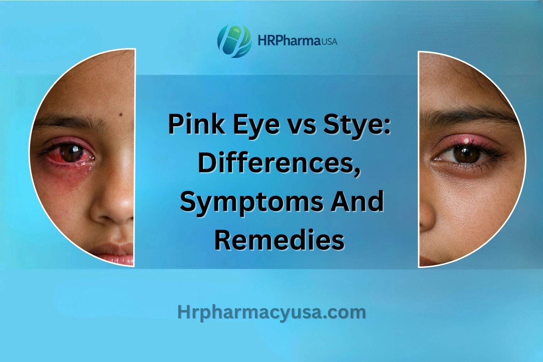 Pink Eye vs Stye: Differences, Symptoms And Remedies