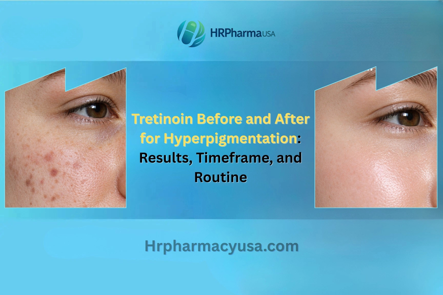 Tretinoin Before and After for Hyperpigmentation: Results, Timeframe, and Routine